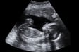 Vanishing Twin Syndrome image