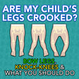 Are My Child's Legs Crooked? Bow Legs, Knock-Knees & What You Should Do image