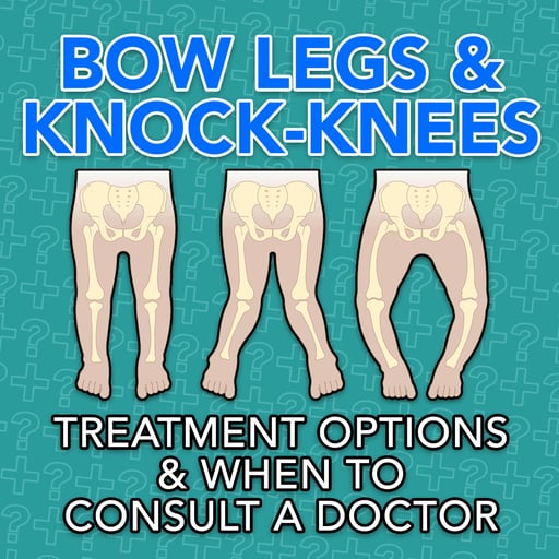 Bow Legs & Knock-Knees: Treatment Options & When to Consult a Doctor