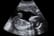 Vanishing Twin Syndrome image