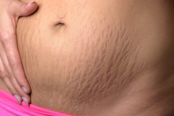 Common Pelvic Floor Problems After Twins image