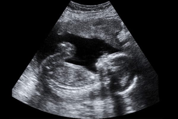 Vanishing Twin Syndrome image