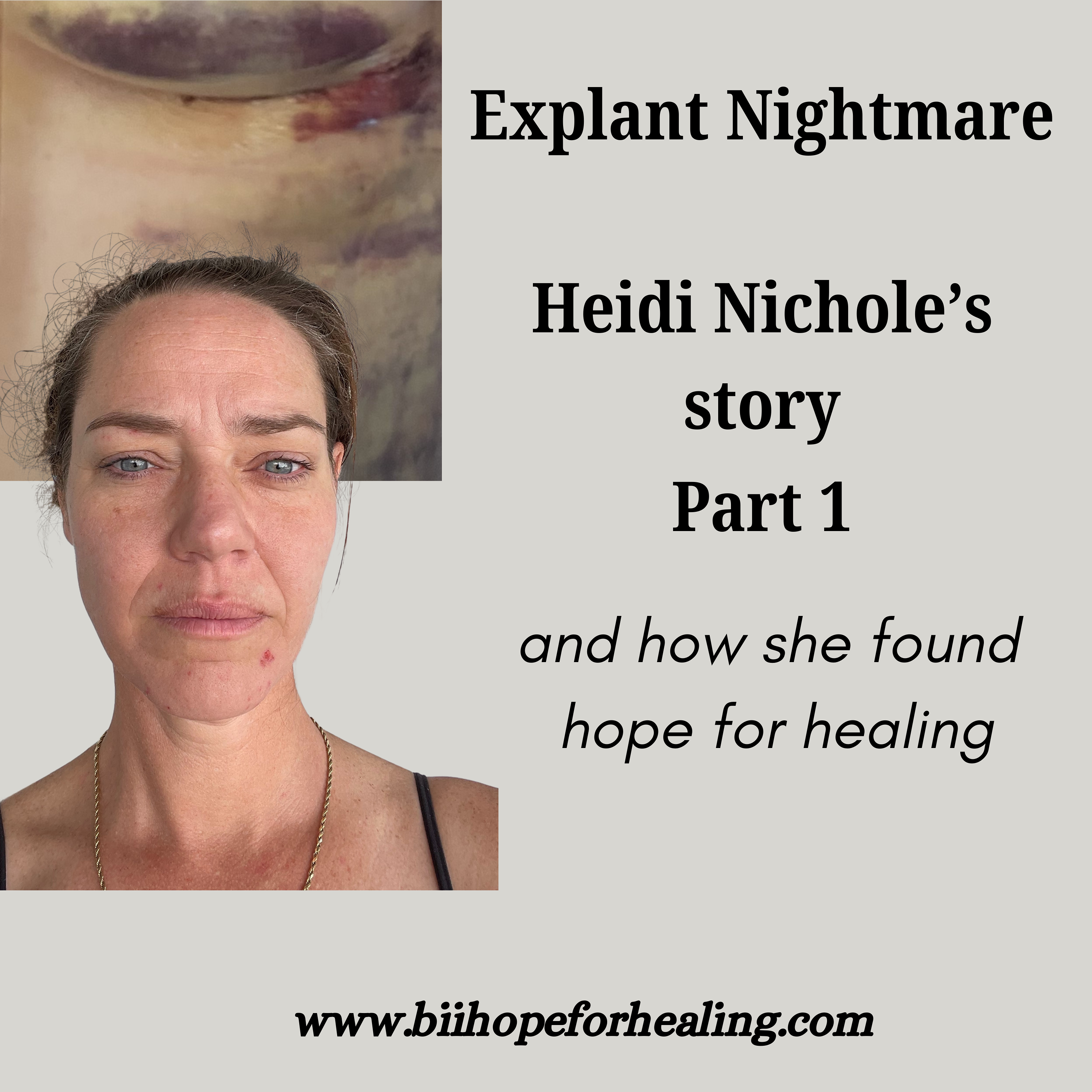 Breast Implant Illness Hope for Healing